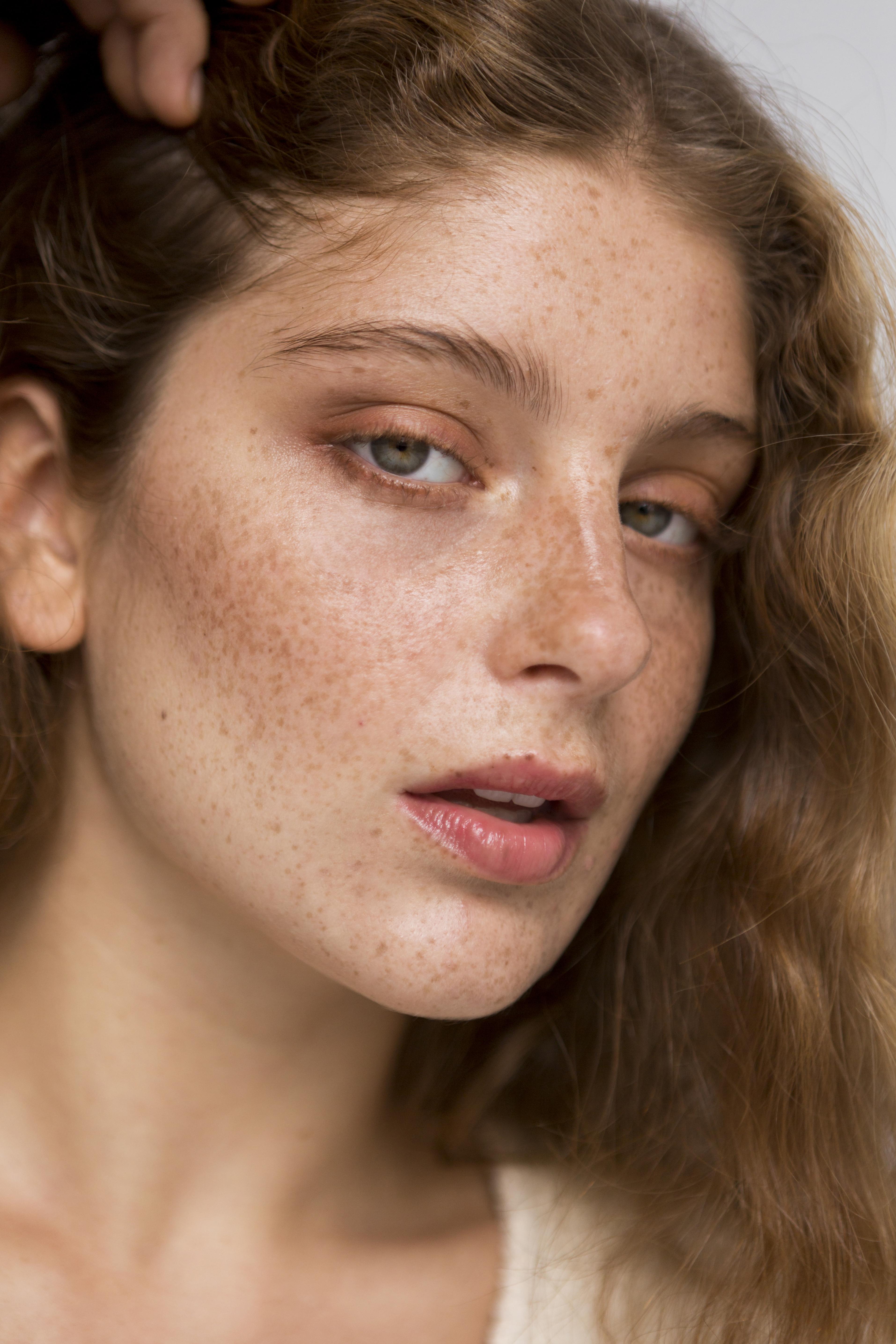Hyperpigmentation & Dark Spots